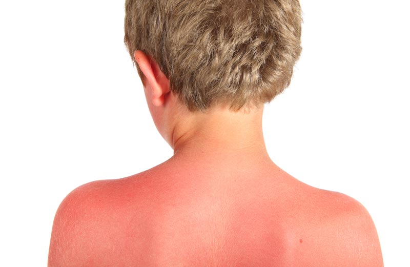 young boy with sunburned back